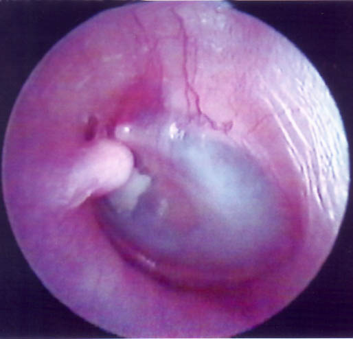 Left Anterior Superior External Auditory Canal Osteoma