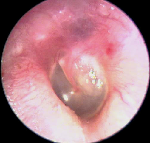 External Auditory Canal Osteoma - Post Op