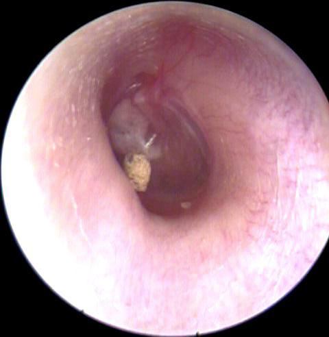 Rock Foreign Body in the Ear Canal