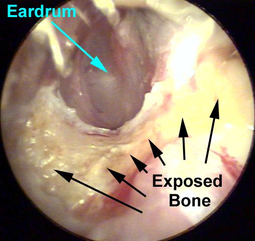 Exposed Bone In Ear Canal from a Button (Hearing Aid) Battery Foreign Body