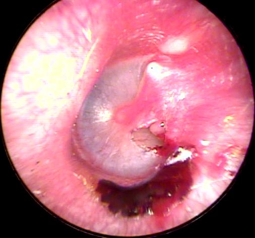 Eardrum Perforation from a Stick Foreign Body. 