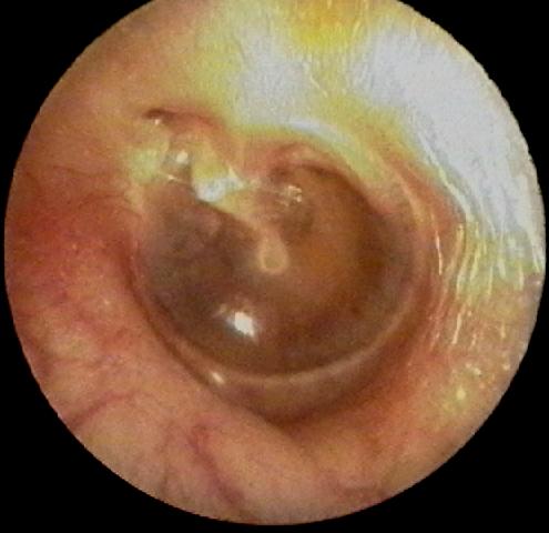 Cholesteatoma: A Serious Ear Condition