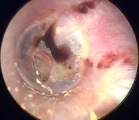 Traumatic Eardrum Perforation Involving the Central Eardrum