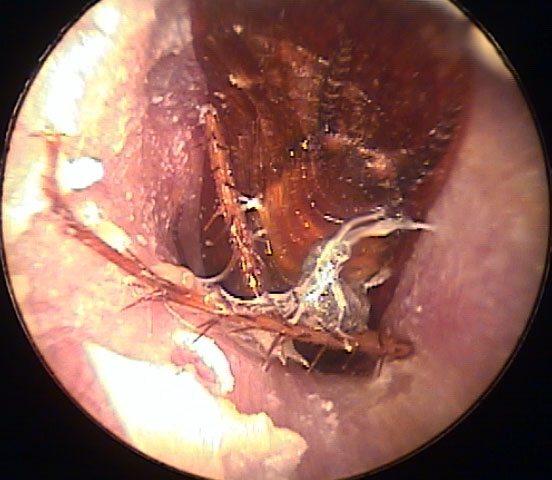 Large Insect in the Ear Canal