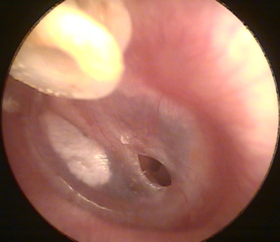 Perforation of a Hole in an Eardrum Caused by an Ear Tube