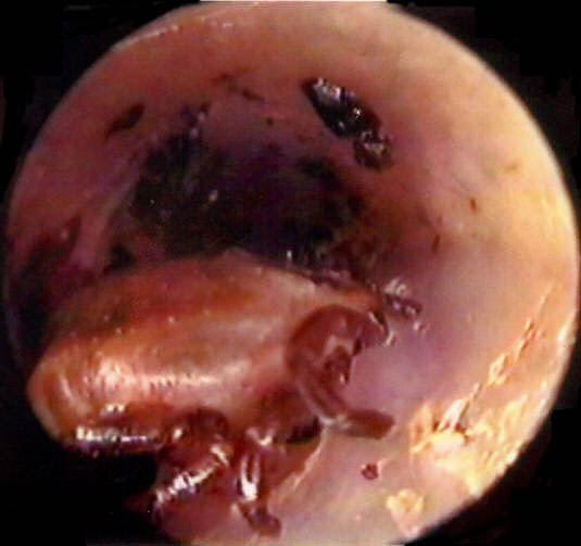 Picture of a Tick in the Ear Canal