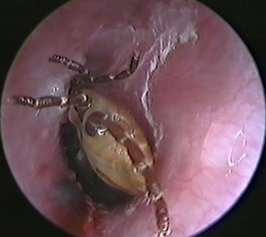 Tick in the External Auditory Canal