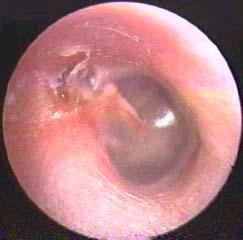 Attic Cholesteoma with an Otherwise  Normal Eardrum