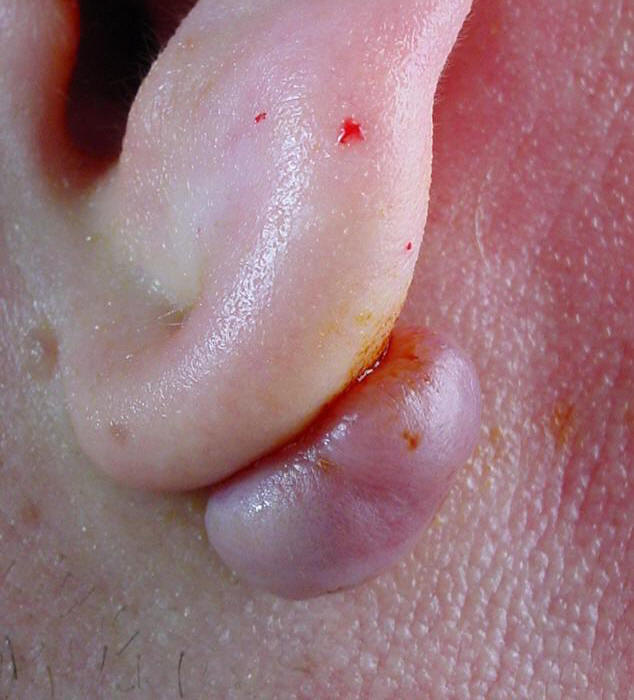 Left Ear Keloid From A Pierced Ear Ring 