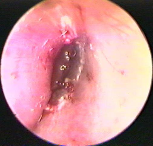 Ear Canal Fracture