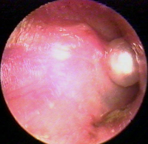 Bead in the Ear - External Auditory Canal