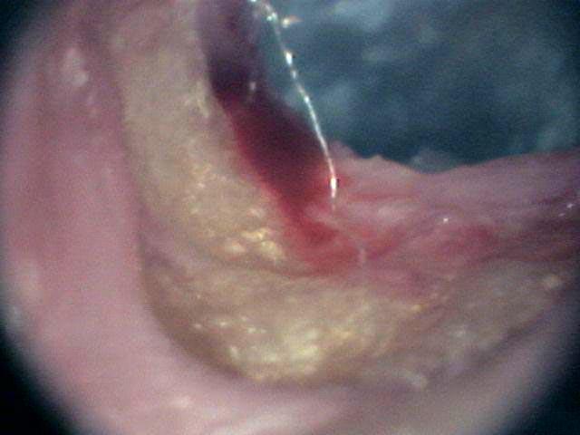 Exposed Bone in the Ear Canal