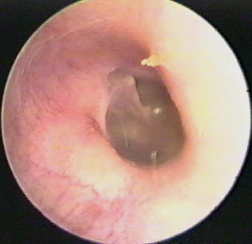 Normal Ear Canal and Eardrum