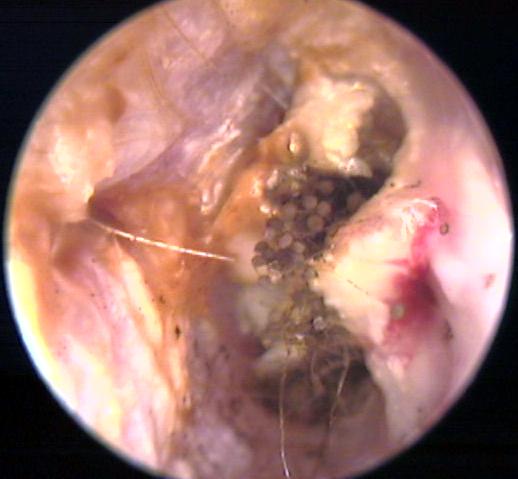 Otomycosis - Fungus, hyphae and spores in the Ear Canal