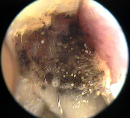 Fungus, spores and hyphae  in the right Ear Canal