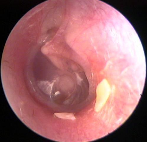 Retracted Eardrum with Tympanosclerosis  Draped over the Promontory.