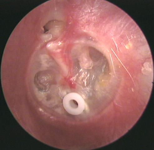 Ear Tube Placed in a Severely Retracted Eardrum