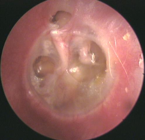 Eardrum with Chronic Serous Otitis Media and an Attic Retraction Pocket