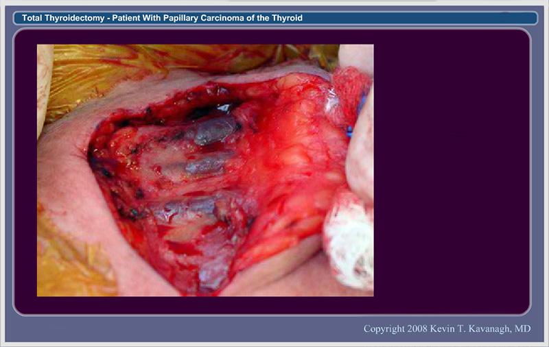 3.  Exposure of Anterior Cervical Veins