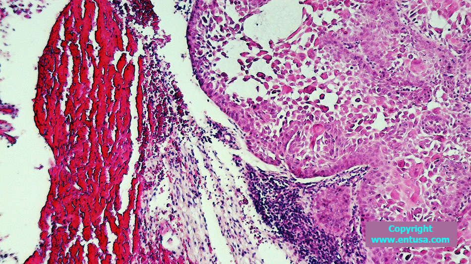 Squamous Cell Carcinoma of the Larynx