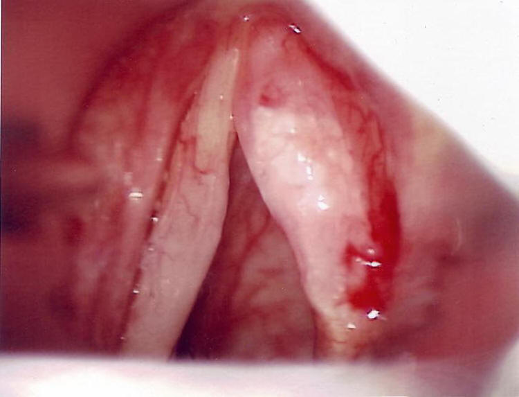 T1 Larynx Cancer on the Anterior Right True Vocal Cord In a Smoker