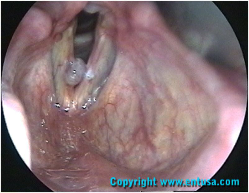 Large Right Vocal Cord Nodule