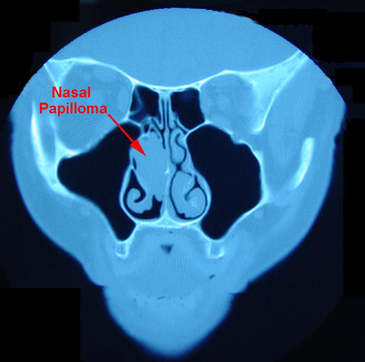 nasal papilloma ct)