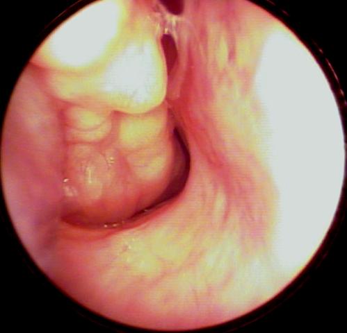 Picture of Papilloma  in Right Nasal Cavity