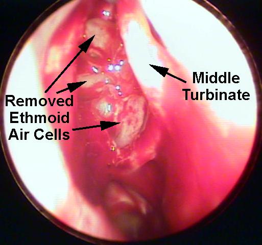Ethmoidectomy - Fess - Functional Endoscopic Sinus Surgerya