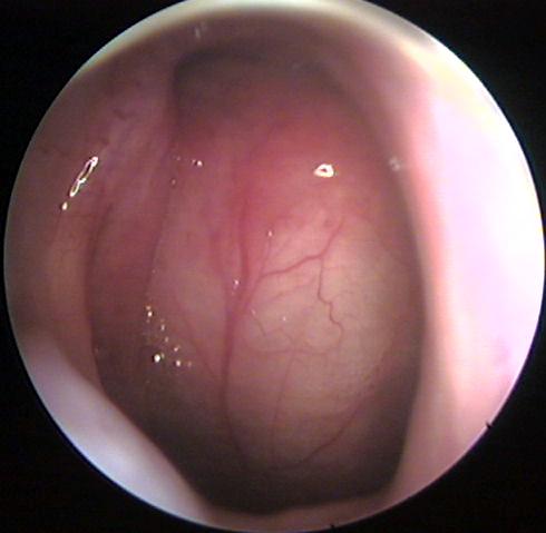 Tornwaldt's Cyst of the Nasopharynx