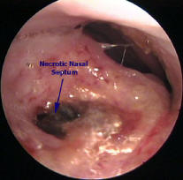 Nasal Septal Necrosis with Impending Nasal Perforation in a Pateint Treated with Nasal Steroids for Nasal Allergy