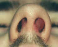 Nasal Septal Hematoma