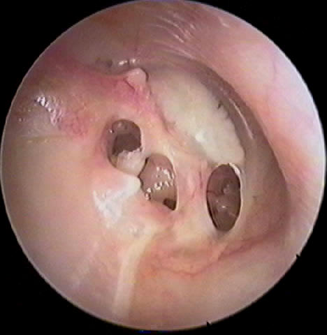 Eardrum with Multiple Perforations and Tympanosclerosis