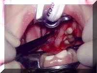 Drainage of a Peritonsillar Abscess - Quinsy Tonsillectomy