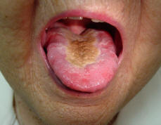 Geographic Tongue Symptoms Causes