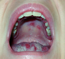 Oral candidiasis caused by inhalation steroids