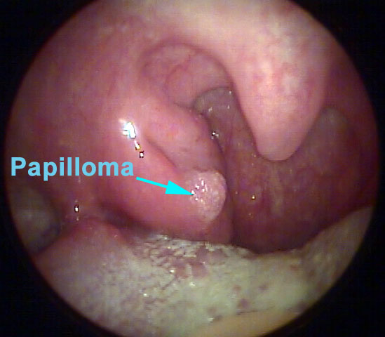 papilloma on throat