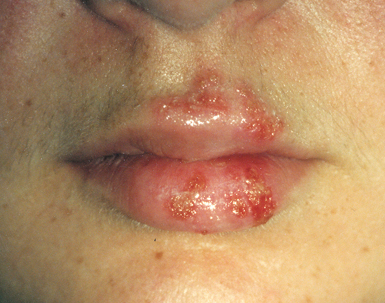 What is a white bump on the inside of your lower lip?
