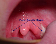 Small Tonsils