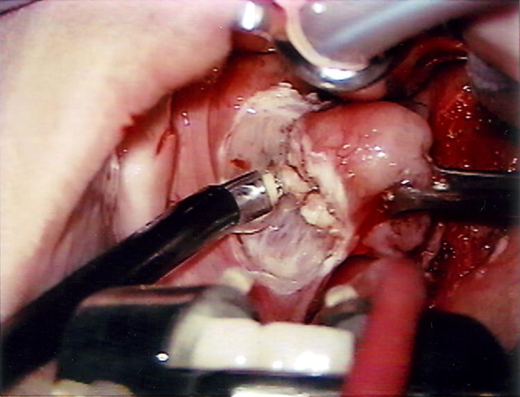 Adult Tonsil Surgery 2