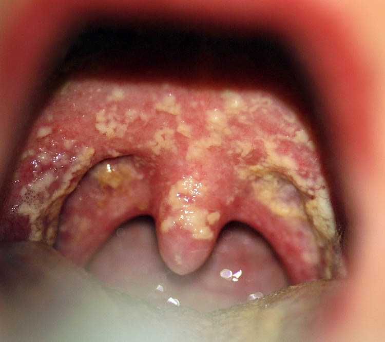 Candidiasis In The Mouth 65