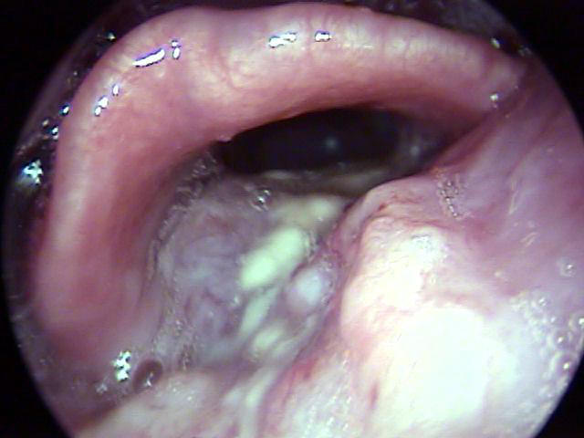 Squamous Cell Carcinoma Picture Image on MedicineNet.com
