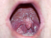 Oral candidiasis caused by inhalation steroids