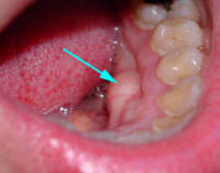 Pictures Of Mouth And Tongue Disease