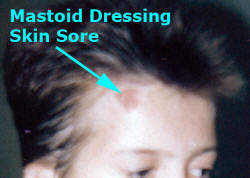 Mastoid Dressing Skin Sore Caused by Too Tight Dressing Application