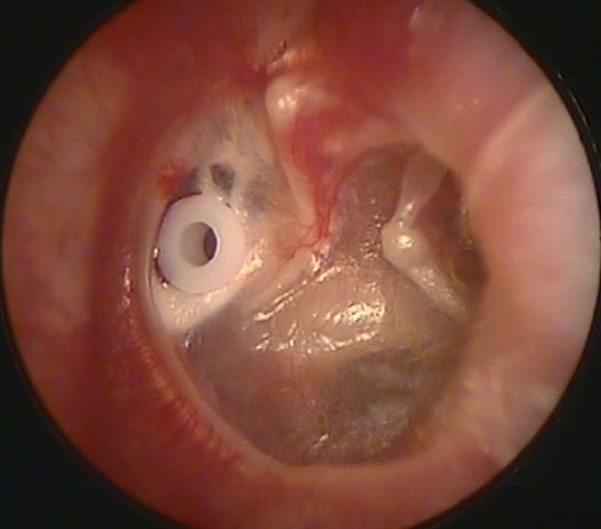 Atelectatic Retracted Eardrum with an Eartube and a Myringostapediopexy
