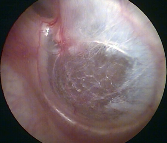 Lateralized Thin Eardrum