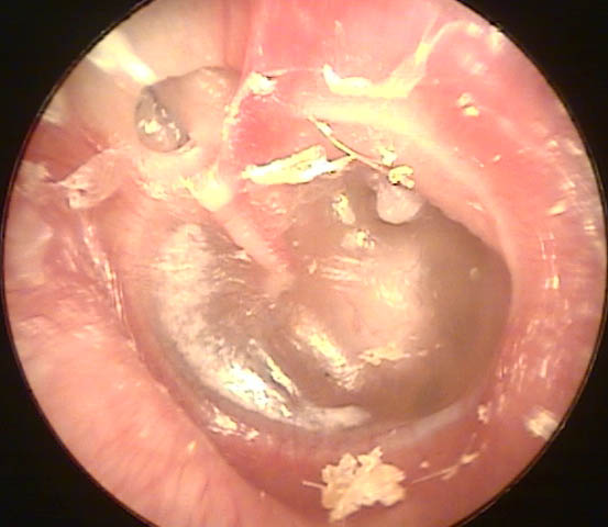 Severely Retracted Eardrum with a Myringostapediopexy and an Attic Retraction Pocket