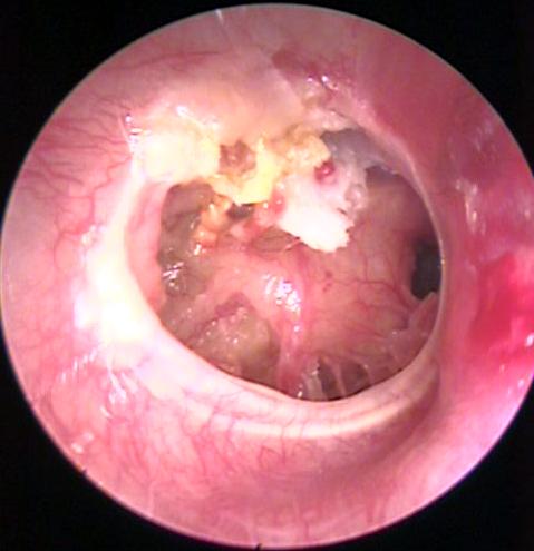 Large Cholesteatoma with a Total Eardrum Perforation