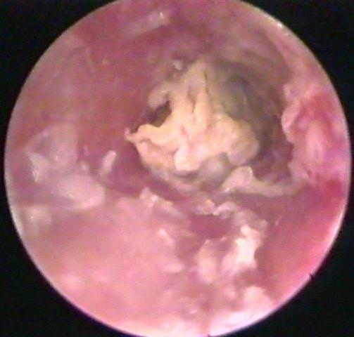 Chronic Otitis Externia with Squamous Debris in the Ear Canal